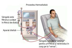 la ce valori ale creatininei se face dializa|Dializa: ce este, cum se desfasoara si cand este。